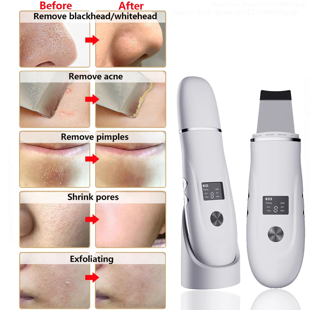 Ultrasonic Skin Scrubber